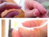 Трещины на пальцах рук: причины и методы лечения