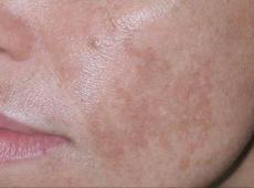 Пигментация кожи: причины, последствия и способы лечения